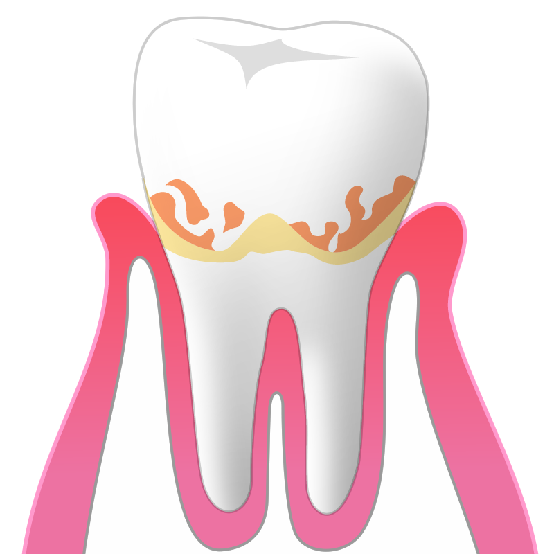 歯肉炎（G）：歯周ポケットの深さ1～3mm